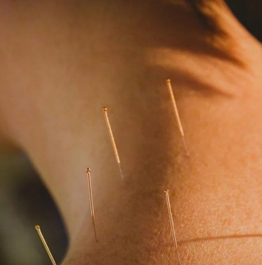 dry needling